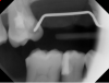 Fig 47. Post-treatment radiograph shows carious area removed and area sealed and ready for endodontic treatment and restoration.