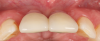 Fig 17. Clinical comparison of the volumetric gain obtained with the intervention, occlusal views. Fig 17: Occlusal view at baseline. Fig 18: Occlusal view at 1-year post-treatment.