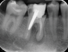 Fig 1. Root perforation caused by improper preparation and placement of an oversized post (dentistry courtesy of Riccardo Tonini, MD, DDS).