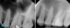 Fig 1 Using the endo-restorative workflow described in this article, the complex anatomy shown in these radiographs was able to be irrigated by multisonic
irrigation. Fig 1, left panel: Preoperative radiograph of tooth No. 14 with acute periapical abscess and dental caries in a 20-year-old male patient with good dental
and overall health. A filling had broken, and the patient had postponed treatment. Fig 1, right panel: Postoperative radiograph (after the single-visit endo-restorative
workflow). Fig 2, left panel: Preoperative radiograph of tooth No. 30 with internal inflammatory root resorption, a rare condition, resulting in acute periapical abscess in
another 20-year-old male patient with good dental and overall health. Fig 2, right panel: Postoperative radiograph (after the single-visit endo-restorative workflow).
