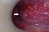 Fig 1. An intraoral examination using incandescent light showed a pink papule at the posterior lateral border of the tongue, identified by the white arrow. (photographs in Fig 1 and Fig 2 courtesy of Kevin D. Huff, DDS, Dover, Ohio)