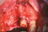 Figure 1  Full-thickness flap reflection exposed the left lateral incisor, which was fractured and intruded apically beyond the alveolar housing.