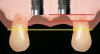 Figure 3  When adjacent implants are placed 3 mm or more apart and the interproximal crest of bone is retained (ie, red line), the papilla between the implants may be within 1 mm to 1.5 mm of the original papilla height (ie, yellow line).