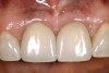 Figure 9  The final restorations exhibit a minimal 1-mm to 1.5-mm change in papilla height when compared with the pre-extraction height.