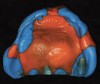 Figure 7  Maxillary final impression made with vinyl poly siloxane material in a custom tray.