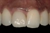 Figure 12  Postoperative clinical photograph revealed maintenance of the gingival architecture and esthetic outcomes.