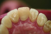 Figure 5 and Figure 6. All-ceramic restorations (Figure 5) and opposing dentition wear (Figure 6) produced by all-ceramic feldspathic restorations.