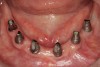 Figure 1  When there is a lack of attached gingiva, the typical finding is a keratinized margin with mucosa (site Nos. 23 and 26).
