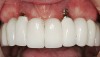 Figure 3  Some sites without keratinized gingiva, such as Nos. 7 and 10, manifest an increased amount of inflammation in response to plaque compared to other locations with keratinized gingiva (eg, site Nos. 5 and 12).