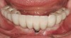 Figure 6  Absence of keratinized tissue often does not result in additional recession. Site No. 24 demonstrates recession at time of crown insertion (Fig 6). Fig 7 demonstrates that the tissue level has remained stable after 1 year. This patient had good oral hygiene.