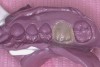 Figure 3  PVS template is removed from mouth after 75 seconds with interim crown in template.