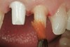 Figure 5  Crown preparations for implant abutment maxillary right central incisor and natural tooth left central incisor. Water-soluble lubricant is painted on preparation surfaces as a release agent.