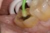 Figure 4  Application of a self-etching adhesive immediately after completion of tooth preparation.