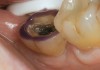 Figure 11  Enamel was etched with phosphoric acid prior to application of self-etching adhesive during cementation phase of the appointment.