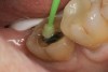 Figure 12  Adhesive applied to tooth