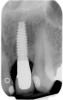 Figure 4  Radiograph of the implant restoration in the maxillary left lateral incisor shown in Figure 3.