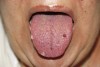 Figure 1  Candidiasis and hemorrhagic blisters on dorsum of tongue.
