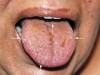 Figure 2  Erosion and scarring of dorsal surface of tongue (arrows).