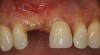 Figure 1  Patient missing maxillary right central incisor presents with ridge deficiency.