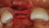 Figure 3  Initial crestal corticotomy/depth cut.