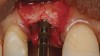 Figure 5  Osteotome expansion of the maxillary ridge.