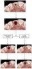 Figure 1   Schematic representation of the importance of socket preservation. (A). Occlusal view of a tooth intended for extraction. (B). The socket after atraumatic extraction. (C). The socket was allowed to heal by clot alone. (D). Postextraction collapse of the buccal socket wall, hindering correct implant placement. (E). The postextraction socket filled with bone augmentation material and collagen wound dressing, and secured with sutures. (F). The proper bone volume is available, allowing prosthetically correct implant placement.