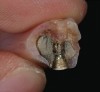 Figure 2  Failures of fixed and removable implant prostheses: acrylic fracture (Fig 1); and framework fracture (Fig 2).