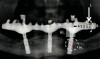 Figure 3  Conceptualization of stresses and strains encountered for a mandibular prosthesis supported by dental implants. High magnitude masticatory forces (i.) are enacted through long lever arms (ii.), creating bending moments and force magnification in the components (iii.). The forces cause deformation in the prosthesis and challenge the integrity of the implant-abutment interface. The transmitted forces are further encountered at the implant bone interface (iv.).