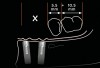 Figure 7  A-P spread in clinical situations. Providing a single premolar and a single molar (16.5 mm in length) in the distal cantilever requires approximately 10 mm A-P spread (X) to maintain a 1.5:1 relationship (Fig 7). The parallel placement of the implants resulted in approximately 4 mm to 5 mm of A-P spread (Fig 8). The divergent placement of the implants resulted in approximately 10 mm of A-P spread measured at the abutment/prosthesis interface (Fig 9).