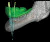 Figure 9  A-P spread in clinical situations. Providing a single premolar and a single molar (16.5 mm in length) in the distal cantilever requires approximately 10 mm A-P spread (X) to maintain a 1.5:1 relationship (Fig 7). The parallel placement of the implants resulted in approximately 4 mm to 5 mm of A-P spread (Fig 8). The divergent placement of the implants resulted in approximately 10 mm of A-P spread measured at the abutment/prosthesis interface (Fig 9).