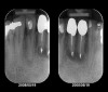 Figure 2  Initial periapical radiographs showing failed endodontic treatment of Nos. 24 and 25, and root resorption, No. 26.