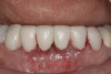 Figure 5  Seven-unit bisacryl provisional bridge—Nos. 22 through 28—fabricated by restorative dentist.