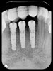 Figure 6  Confirmed ideal implant alignment with pontics in provisional bridge from Nos. 22 through 28—post-placement periapical view.