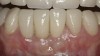 Figure 7  Finished feldspathic crowns, teeth Nos. 22, 23, 27, 28, and implant sites 24 through 26 showing good gingival emergence profile—post-cementation facial view.