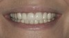 Figure 8  Full smile—finished feldspathic crowns on teeth Nos. 22, 23, 27, and 28; implant crowns in sites 24 through 26; esthetic harmonization with opposing dentition.