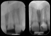 Figure 10  Tooth No. 9, pretreatment, showing Ellis Class III crown fracture; completed endodontic treatment, provisional post and core—periapical views.