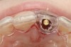 Figure 14  Appropriate alignment of immediate temporary abutment, central axis of implant with cingulum area of surgical guide, incisal view.