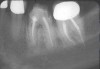 Figure 2  The mandibular first molar is hopeless due to presence of a vertical fracture. At the time treatment was performed, techniques were not available to ideally position an implant of desired dimension at the time of molar extraction.