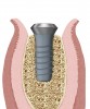 Figure 5  An implant placed in an atrophic mandibular ridge. Use of an implant design with a straight-walled 4.8-mm-diameter body, a 6.5-mm-wide restorative platform, and a flare of the implant supracrestally from the body diameter to the restorative platform diameter results in maximum preservation of residual alveolar bone on the buccal and lingual aspects of the implant.