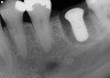 Figure 8  A straight-walled implant with a 4.8-mm diameter and a 6.5-mm restorative platform diameter has been placed in the interradicular bone following tooth sectioning and removal. Primary stability has been attained.