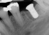 Figure 9: Following manipulation of the interradicular bone, implant placement, and performance of concomitant regenerative therapy, the hard tissues are mature and the implant is ready for restoration.