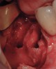 Figure 12  After the first molar was extracted and hemisected without damaging the interradicular bone, an initial osteotomy was prepared in the interradicular bone utilizing a 2.2-mm-wide bur.