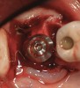 Figure 14  An implant with a 4.8-mm-wide body and a 6.5-mm-wide restorative platform was placed in the interradicular bone following appropriate preparation.