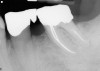 Figure 17  In another case, the mandibular left second molar was fractured and hopeless.