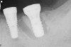 Figure 18  Following hemisection and extraction of the hopeless molar, implants were placed in the first and second molar positions, utilizing specific interradicular bone preparation techniques. Note the positioning of the implant in the second molar site so as to provide adequate dimension for ideal placement of an implant in the first molar area.