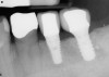 Figure 19  A radiograph taken after 46 months in function demonstrates the stability of the crestal peri-implant bone around both implants.