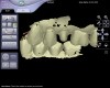 Figure 2  Buccal scan recording to virtually align the opposing digital models using the Lava C.O.S. system.