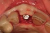 Figure 20  (Case 2) Lingual incision at uncovery to develop facial tissue.