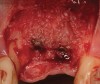 Figure 26  (Case 3) Augmentation with demineralized freeze-dried bone allograft.