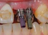 Figure 29  (Case 3) Proximity of impression copings.